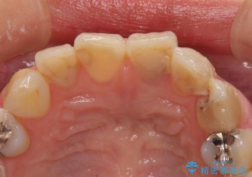 大きなむし歯と欠損をセラミックに　部分矯正を併用した総合歯科治療の治療前