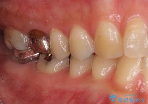大きなむし歯と欠損をセラミックに 部分矯正を併用した総合歯科治療の治療前