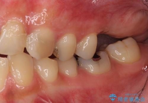大きなむし歯と欠損をセラミックに　部分矯正を併用した総合歯科治療の治療前
