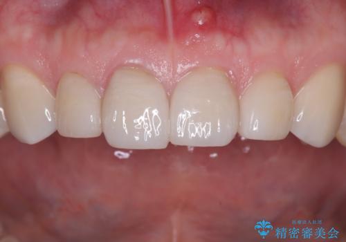 【セラミッククラウン】他院で治療したセラミッククラウンをやりかえたいの治療前