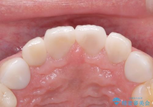 【セラミッククラウン】他院で治療したセラミッククラウンをやりかえたいの治療前