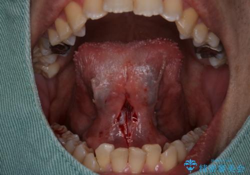 『即日手術』滑舌が悪いのを改善したい!の治療前