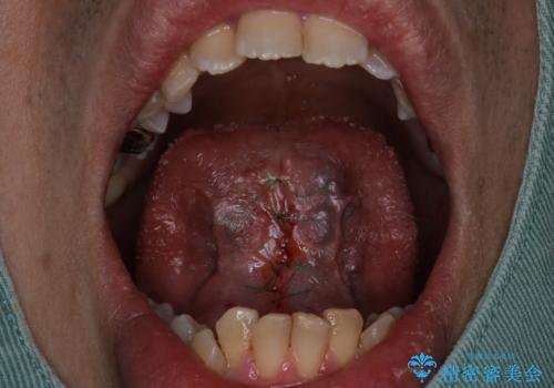 『即日手術』滑舌が悪いのを改善したい!の治療前