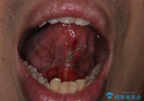 『即日手術』滑舌が悪いのを改善したい!の治療中