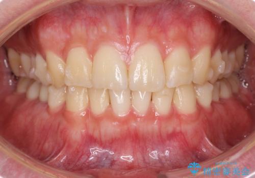 前歯のがたつきをなおしたい マウスピース矯正の治療中