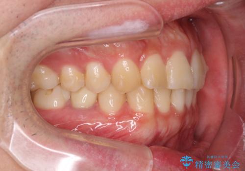 前歯のがたつきをなおしたい マウスピース矯正の治療中