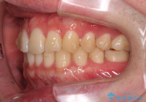 前歯のがたつきをなおしたい マウスピース矯正の治療中