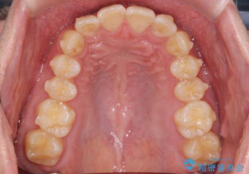 前歯のがたつきをなおしたい マウスピース矯正の治療中
