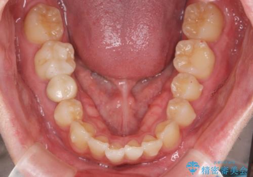 前歯のがたつきをなおしたい マウスピース矯正の治療中