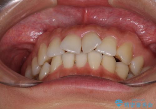 捻れた前歯をインビザラインで整えるの治療前