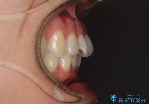 捻れた前歯をインビザラインで整えるの治療前