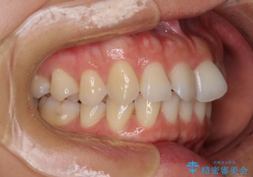 捻れた前歯をインビザラインで整えるの治療前