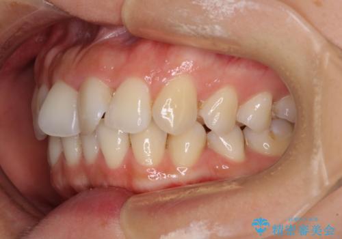 捻れた前歯をインビザラインで整えるの治療前