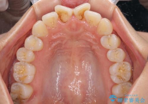 捻れた前歯をインビザラインで整えるの治療前
