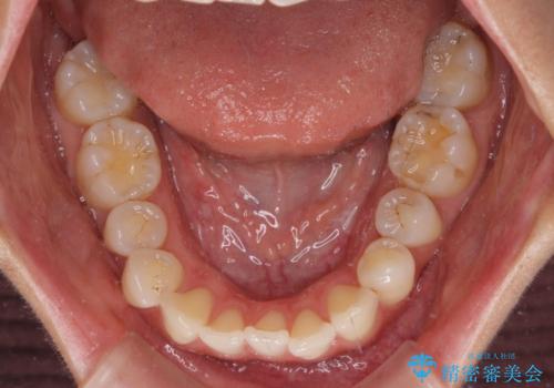 捻れた前歯をインビザラインで整えるの治療前