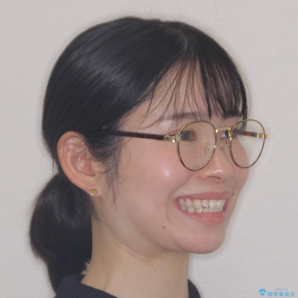 【モニター】口が閉じにくい 膨らんだ口元を抜歯矯正ですっきりとの治療前(顔貌)