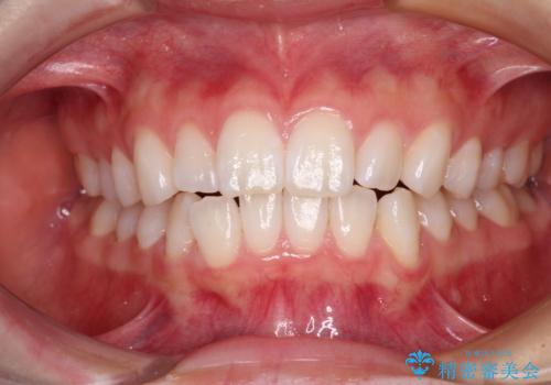 【モニター】口が閉じにくい 膨らんだ口元を抜歯矯正ですっきりとの治療前