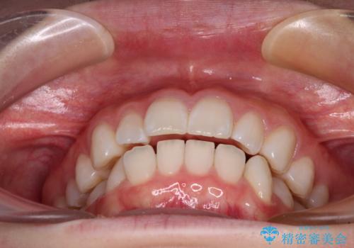 【モニター】口が閉じにくい 膨らんだ口元を抜歯矯正ですっきりとの治療前