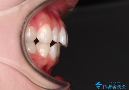 【モニター】口が閉じにくい 膨らんだ口元を抜歯矯正ですっきりとの治療前