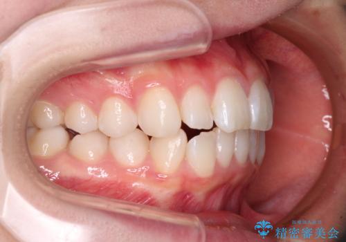 【モニター】口が閉じにくい 膨らんだ口元を抜歯矯正ですっきりとの治療前