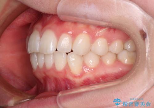 【モニター】口が閉じにくい 膨らんだ口元を抜歯矯正ですっきりとの治療前