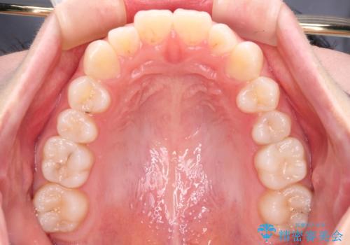【モニター】口が閉じにくい 膨らんだ口元を抜歯矯正ですっきりとの治療前