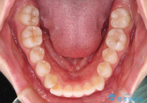 【モニター】口が閉じにくい 膨らんだ口元を抜歯矯正ですっきりとの治療前