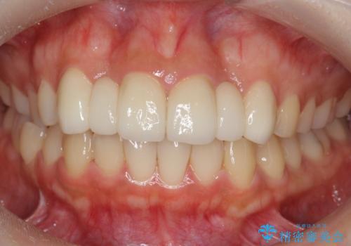 前歯の出っ歯とねじれ　短期間できれいに!　部分矯正とセラミックの組み合わせ治療の症例 治療後
