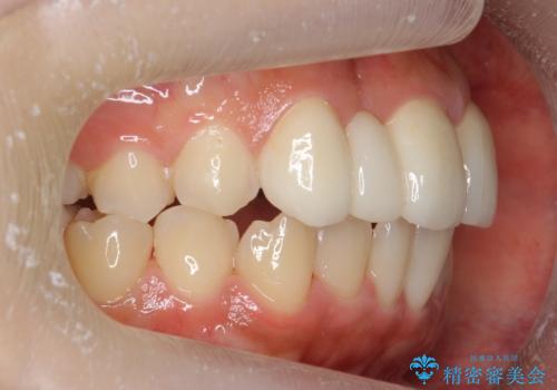 前歯の出っ歯とねじれ 短期間できれいに! 部分矯正とセラミックの組み合わせ治療の治療後