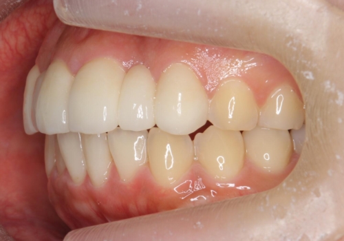 前歯の出っ歯とねじれ 短期間できれいに! 部分矯正とセラミックの組み合わせ治療の治療後