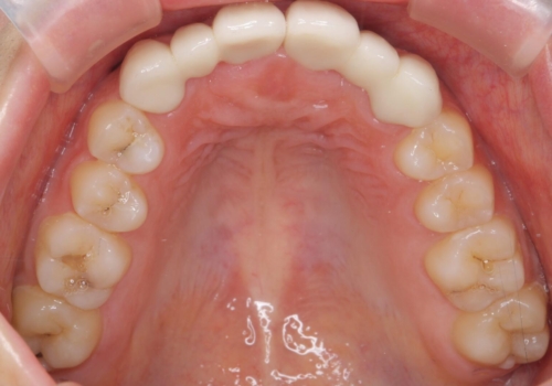前歯の出っ歯とねじれ 短期間できれいに! 部分矯正とセラミックの組み合わせ治療の治療後