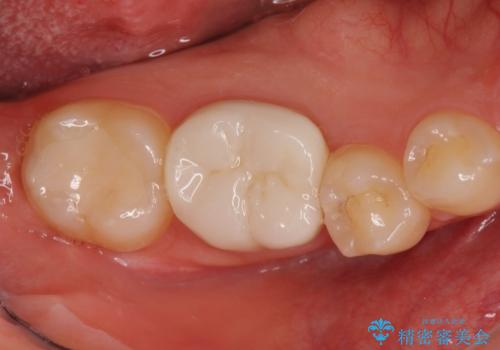 奥歯の高さがない　歯周外科処置で解決　(クラウンレングスニング)の症例 治療後