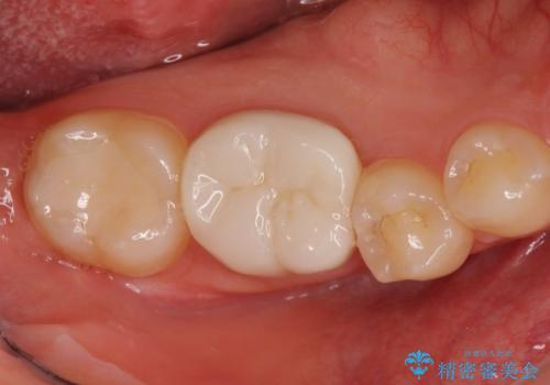 奥歯の高さがない　歯周外科処置で解決　(クラウンレングスニング)の治療後