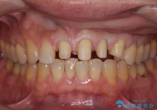 転んで前歯が欠けてぐらぐらに 歯の神経も死んでしまったの治療中