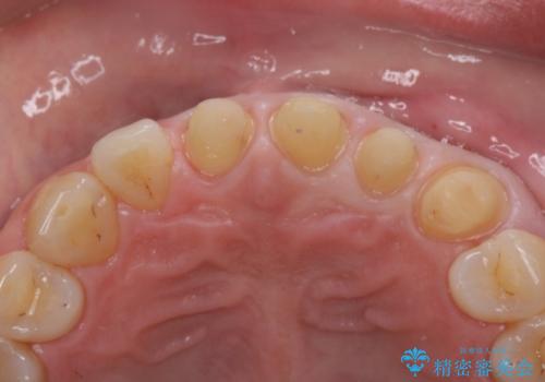 転んで前歯が欠けてぐらぐらに 歯の神経も死んでしまったの治療中