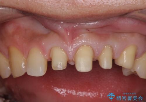 転んで前歯が欠けてぐらぐらに 歯の神経も死んでしまったの治療中