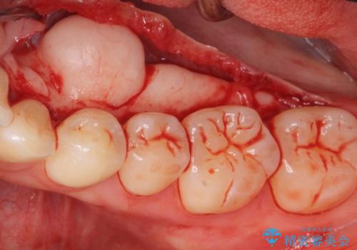 下あごの骨隆起が気になる。の治療中