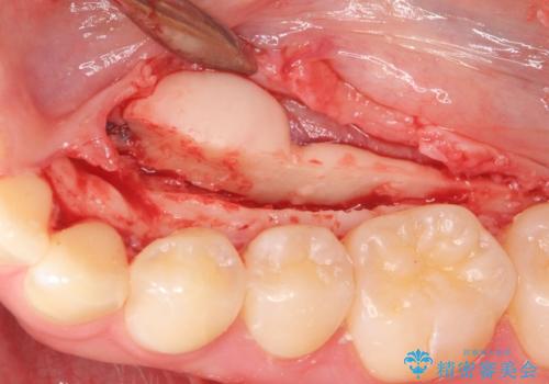 下あごの骨隆起が気になる。の治療中