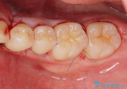 下あごの骨隆起が気になる。の治療後