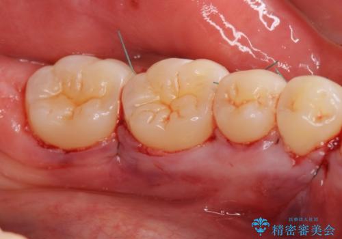 下あごの骨隆起が気になる。の治療中