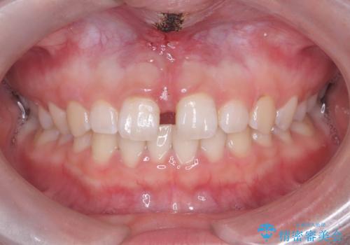 【上唇小帯切除術】子どもの頃から上の前歯の歯茎が気になってた!の治療後