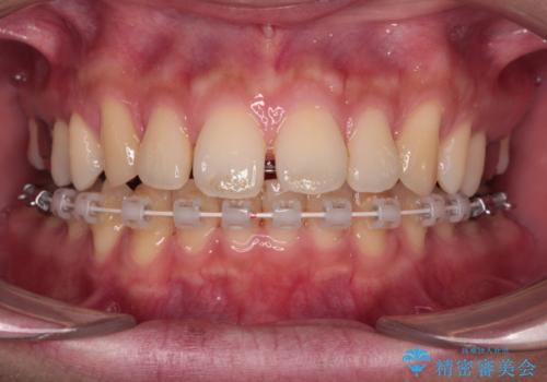 深い咬み合わせと前歯の隙間 ハーフリンガルによる矯正治療の治療中