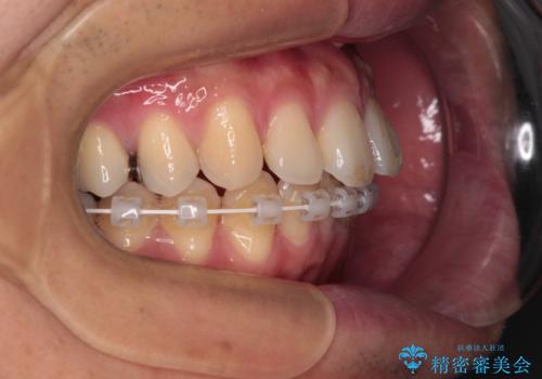 深い咬み合わせと前歯の隙間 ハーフリンガルによる矯正治療の治療中