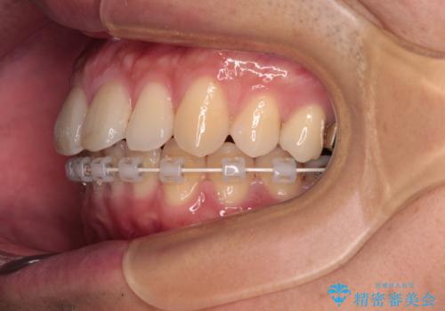 深い咬み合わせと前歯の隙間 ハーフリンガルによる矯正治療の治療中