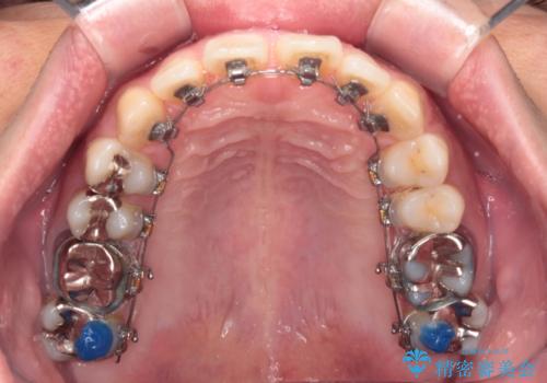 深い咬み合わせと前歯の隙間　ハーフリンガルによる矯正治療の治療中
