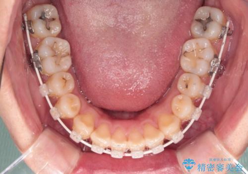 深い咬み合わせと前歯の隙間　ハーフリンガルによる矯正治療の治療中