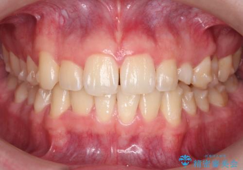 前歯のすき間、犬歯の異所萌出　乳歯を抜かずに矯正の治療中