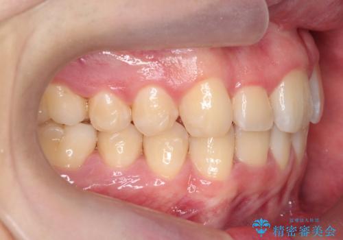 前歯のすき間、犬歯の異所萌出 乳歯を抜かずに矯正の治療中