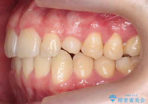 前歯のすき間、犬歯の異所萌出 乳歯を抜かずに矯正の治療中