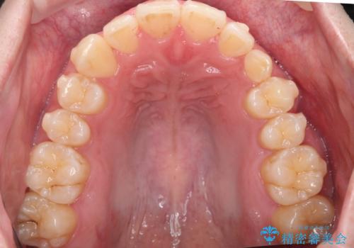 前歯のすき間、犬歯の異所萌出 乳歯を抜かずに矯正の治療中
